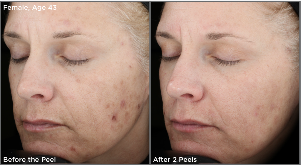 Woman with before and after results of her chemical peel 